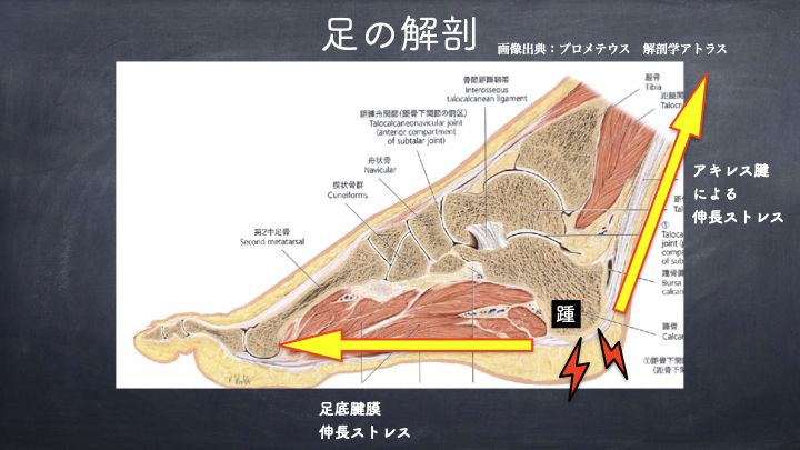 Sever病の原因は伸長ストレス