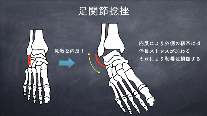 足関節捻挫