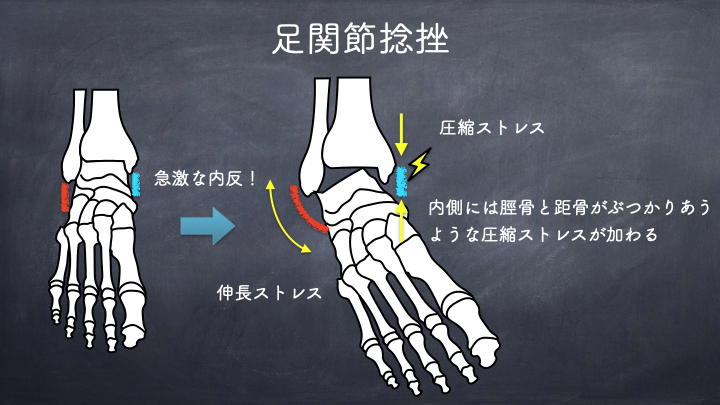 内反捻挫のメカニズム