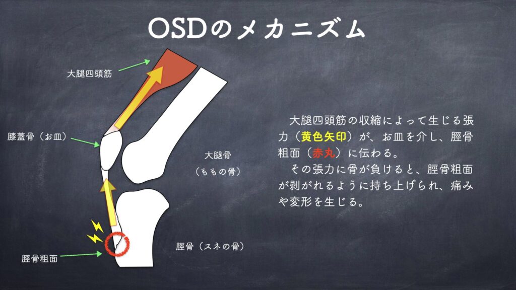 オスグッドを引き起こす身体の使い方