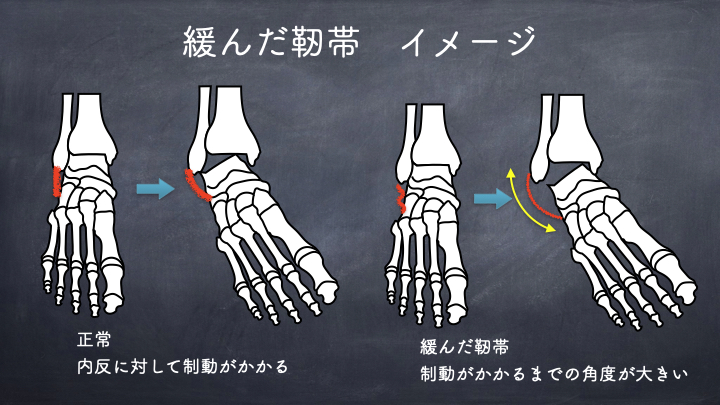 靭帯の緩み