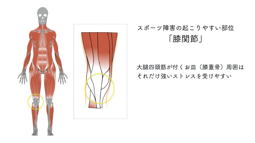 スポーツ障害　膝関節